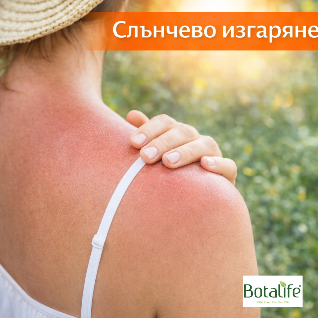 Най-добрите етерични масла при слънчево изгаряне – облекчение със зехтин, кокосово масло, лавандулово и масло от черен кимион